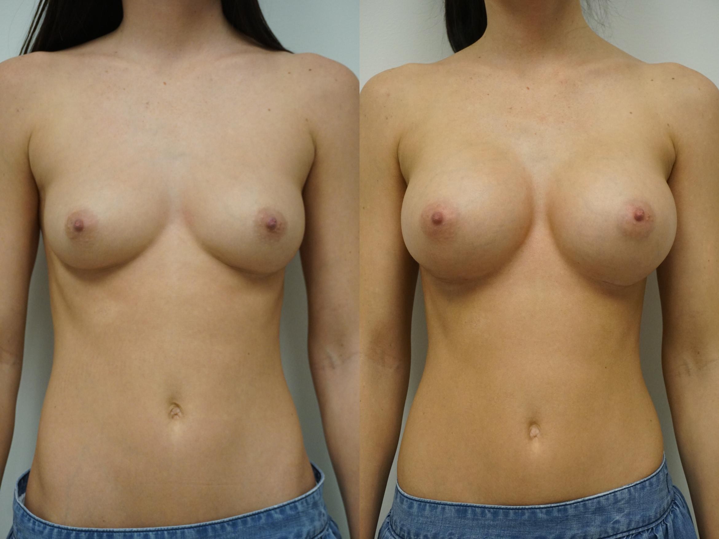 Porn Tits Before And After - Porno Boobs Before and after Plastic Surgery (62 photos) - porn photo